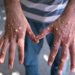 mpox