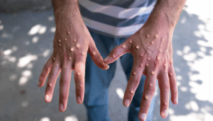mpox